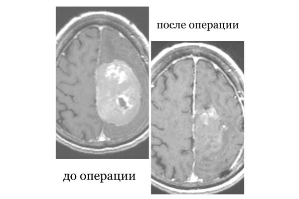 В Бурятии спасли пенсионерку с опухолью мозга, которая отказывалась от операции